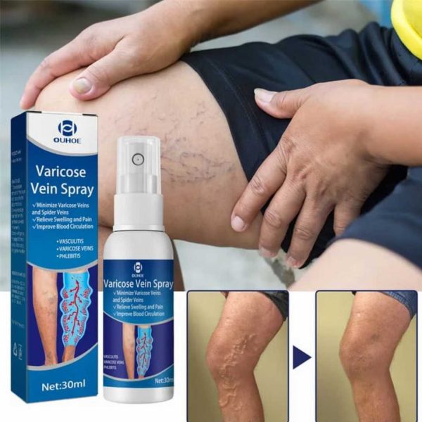Varicose Veins Treatment Spray